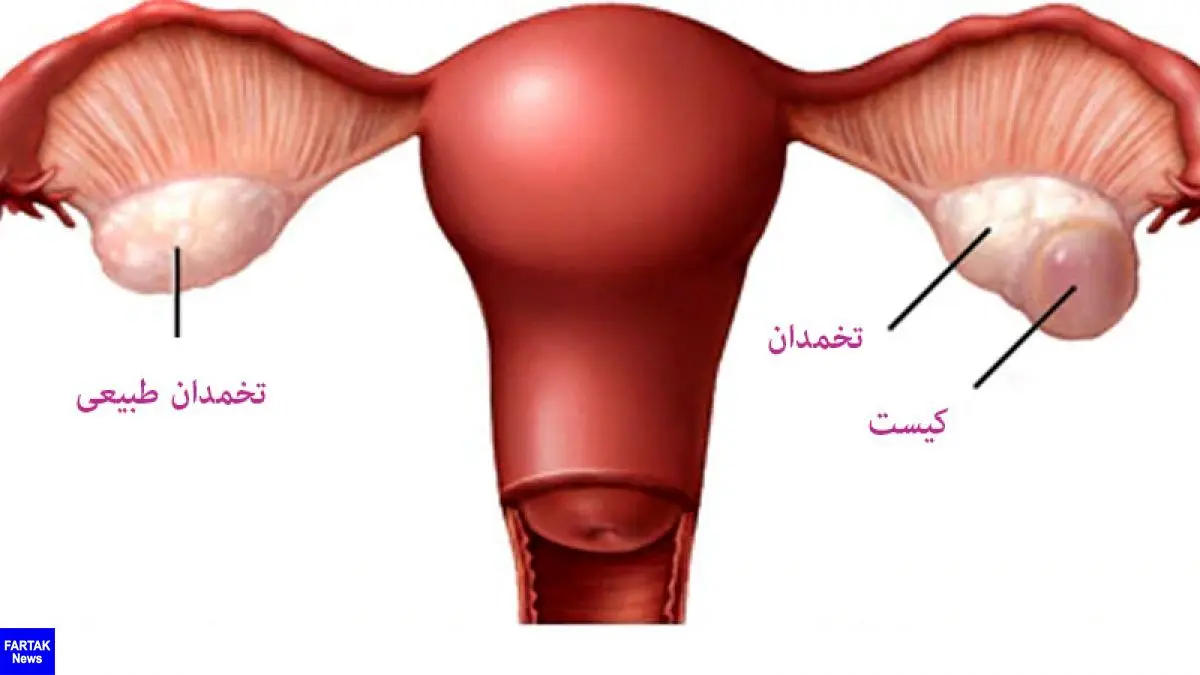 کیست تخمدان چه علائمی دارد؛ به چه روش هایی درمان می شود و راه های پیشگیری از آن چیست؟