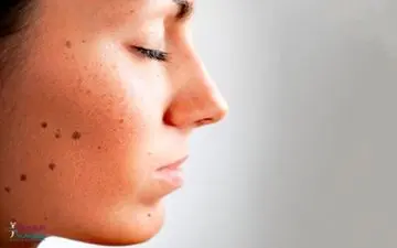 این «خال‌ها» خطرناک هستند | تغییرات خال ها نگران کننده است؟