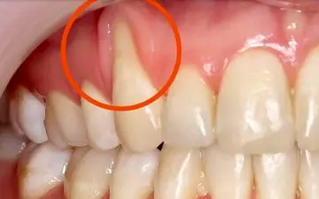 چرا لثه‌هایتان عقب رفته؟ | چگونه از عقب‌رفتگی لثه پیشگیری کنیم؟