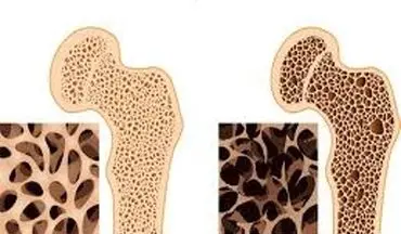  توصیه طب سنتی در رابطه با پوکی استخوان