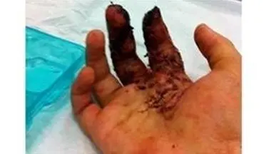 مردی با انگشتان قطع شده در بیمارستان اصفهان قدم می زد !