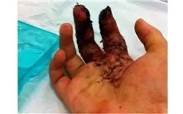 مردی با انگشتان قطع شده در بیمارستان اصفهان قدم می زد !