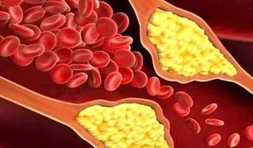 علامت مهم ابتلا به کلسترول خون کدام است؟