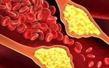 علامت مهم ابتلا به کلسترول خون کدام است؟