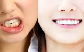 ارتودنسی یا لمینت؟ کدام بهتر است؟