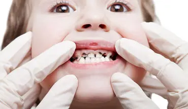 آمار پوسیدگی دندان در بین دانش آموزان رو به افزایش است