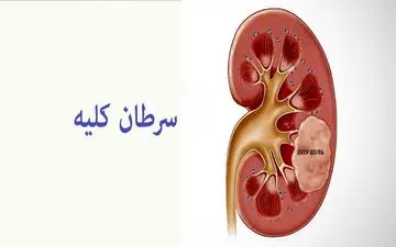 سرطان کلیه: از علائم هشداردهنده تا روش‌های نوین درمان
