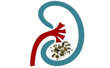 توصیه های غذایی برای پیشگیری از سنگ کلیه