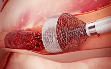 خارج کردن لخته خون از رگ به روشی نوین + فیلم