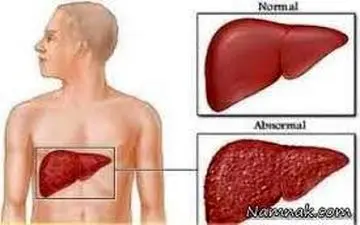 آیا کبد چرب درمان می شود؟ 