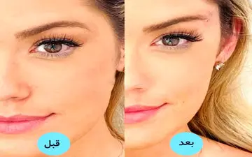 جوان‌تر شدن و زیباتر شدن چشم و ابرو با جراحی لیفت شقیقه