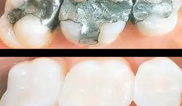  جلوگیری از پوسیدگی دندان با روشی شگفت‌انگیز