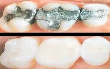  جلوگیری از پوسیدگی دندان با روشی شگفت‌انگیز