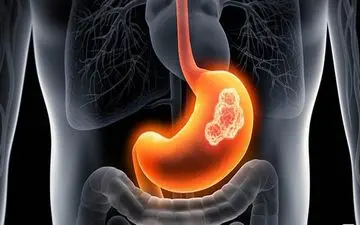 
این "خوردنی‌ها" سرطان زا هستند