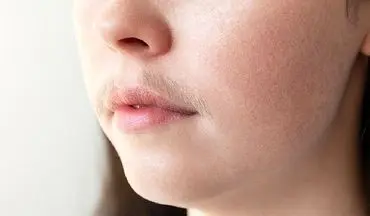 چه زمانی موی صورت در زنان طبیعی است و چه زمانی نیاز به درمان دارد؟
