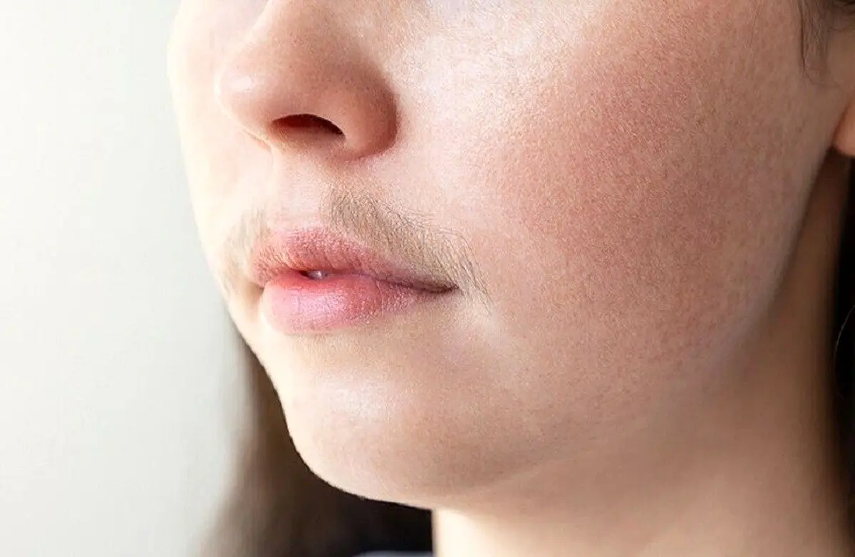 چه زمانی موی صورت در زنان طبیعی است و چه زمانی نیاز به درمان دارد؟