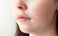 چه زمانی موی صورت در زنان طبیعی است و چه زمانی نیاز به درمان دارد؟