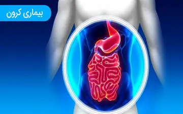  عوامل موثر در ابتلا به کرون