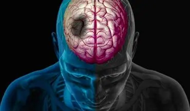 اقدام به‌موقع در مواجهه با سکته مغزی تا چه هنگام است؟