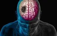 اقدام به‌موقع در مواجهه با سکته مغزی تا چه هنگام است؟
