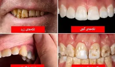 رازهایی که رنگ دندان‌ها درباره سلامت بدنتان فاش می‌کنند