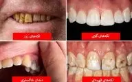 رازهایی که رنگ دندان‌ها درباره سلامت بدنتان فاش می‌کنند