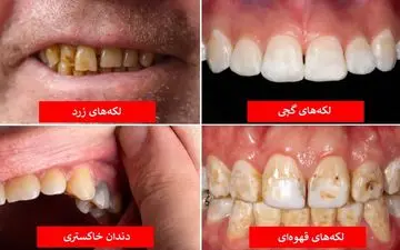 رازهایی که رنگ دندان‌ها درباره سلامت بدنتان فاش می‌کنند