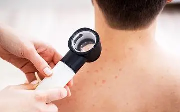 خال های قرمز خطرناک هستند؟