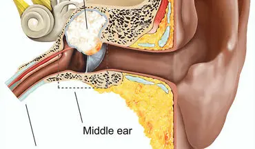 علل ابتلا به کلستئاتوم گوش را بهتر بشناسید