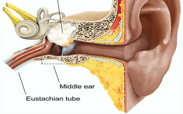 علل ابتلا به کلستئاتوم گوش را بهتر بشناسید
