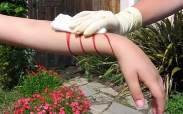 روش های خانگی برای توقف خونریزی