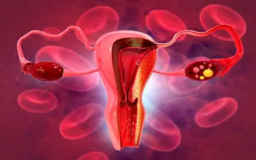 علائم شایع ابتلا به سرطان رحم