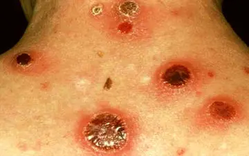 افراد در معرض خطر سیفلیس چه کسانی هستند؟