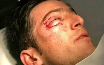 تصویر سردار آزمون بعد از عمل جراحی +تصاویر