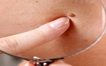 با علائم هشداردهنده خال های سرطانی آشنا شوید 