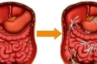 چسبندگی روده: علائم، علل و روش‌های تشخیص آن را بشناسید!