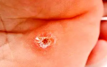 آن چه که باید در مورد میخچه پا بدانید 