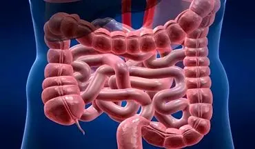 چگونه با رژیم غذایی مناسب خطر ابتلا به سرطان روده را کاهش دهیم؟