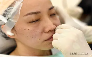 دوام و تاثیر لیفت با نخ در درمان افتادگی صورت
