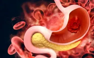 آگاه باشید| سرطان معده را بهتر بشناسید!