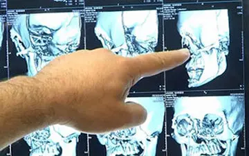 طراحی پروتز کاسه چشم با کمک فناوری چاپ سه بعدی