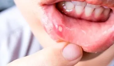 ارتباط سرطان دهان  و زخم های دهان!