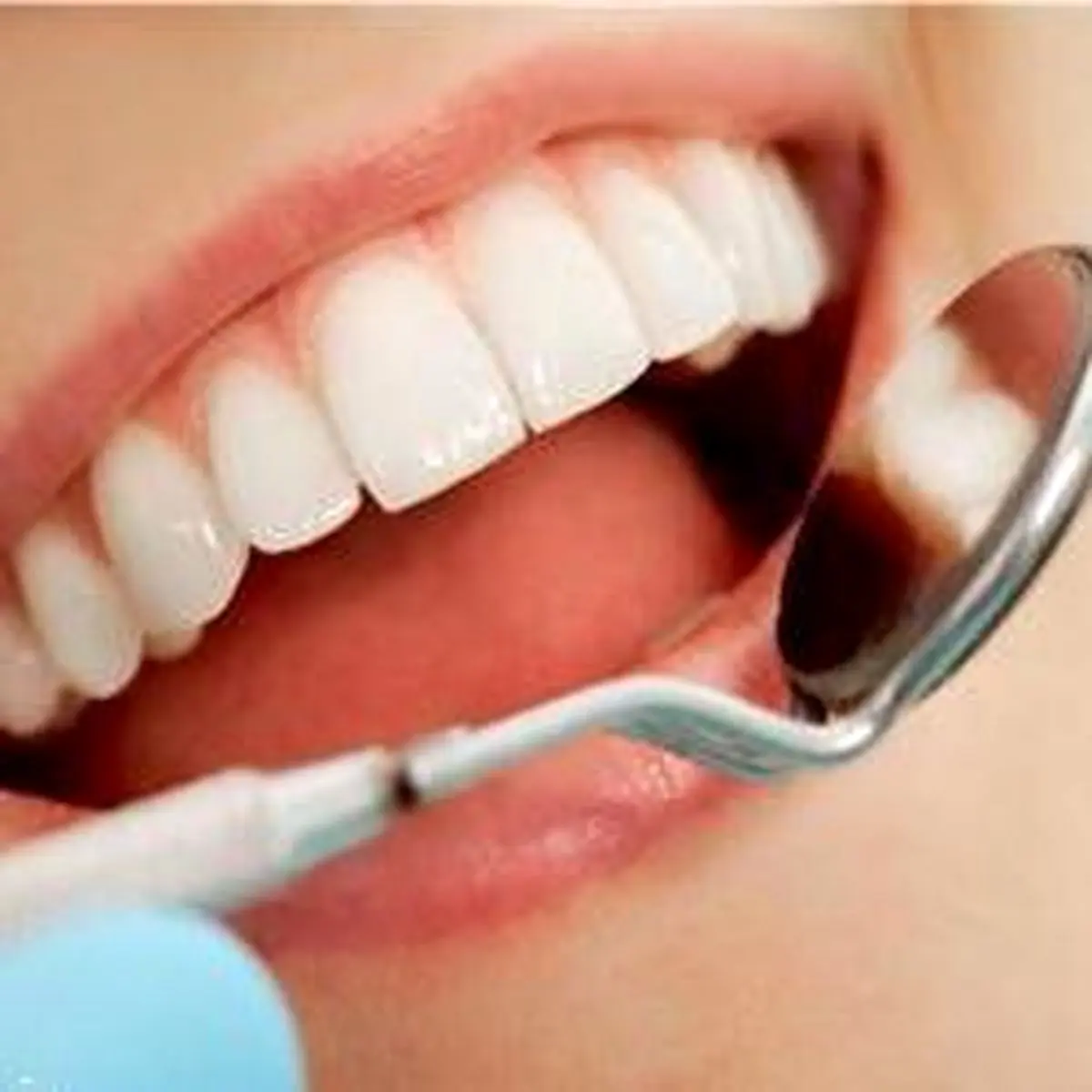 چگونه لکه های سفید روی دندان را از بین ببریم؟ 