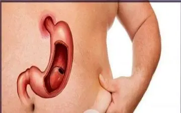 

مزایا و معایب اسلیو معده چیست؟/ حتما بخوانید



