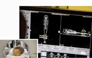 مرد 2 هزارساله قربانی سرطان