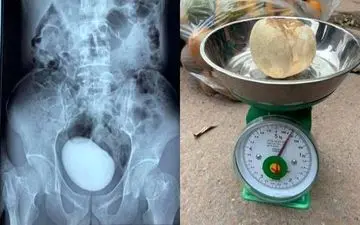 این زن یک سنگ به اندازه سیب زمینی در مثانه‌اش دارد!+عکس