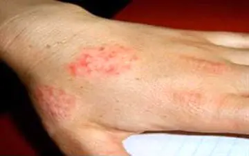 
آیا درمانی برای اگزما وجود دارد؟ 