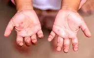 در مورد ویروس دست،پا و دهان چه میدانید؟