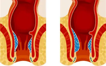 توصیه طب سنتی برای درمان فوری بواسیر و تغذیه مناسب