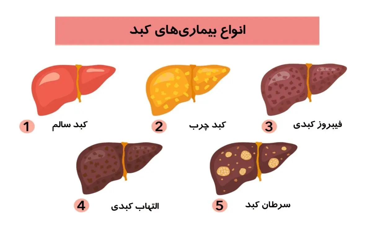 کبد چرب گرید ۳؛ از علائم تا درمان